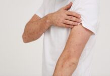 measles