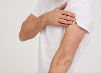 measles