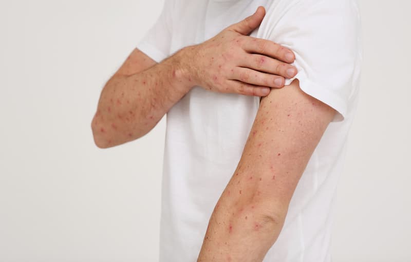 measles